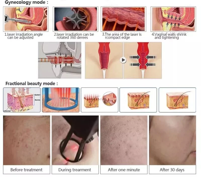 CO2 Fractional Laser Machine Skin Tightening Needle RF Microneedling Machine YAG Laser CO2 Laser Vaginal Rejuvenation Machines Vaginal Hifu