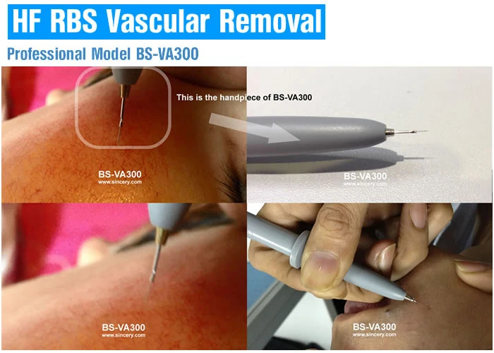 Hf Vascular Skin Tag Removal System