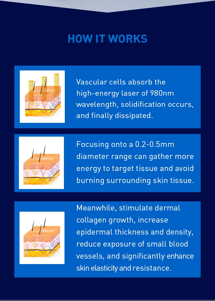 980nm Diode Laser Vascular and Spider Vein Removal