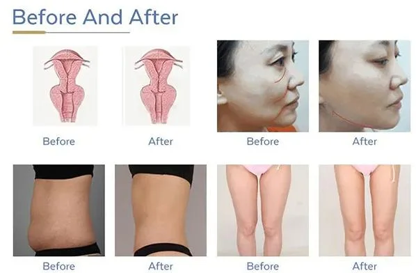 9d Vaginal Hifu 2 in 1 Portable Body Face Slimming Face Lift Vaginal Tightening