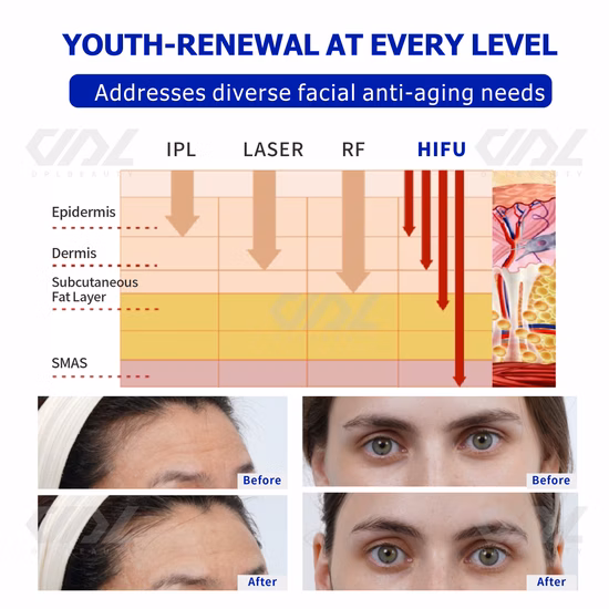 5D 7D Hifu 카트리지 12 라인 성형수술 휴대용 Vmax Hifu 질 강화 바디 슬리밍 4D Hifu