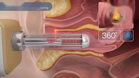 금속 RF 튜브, 튼살 제거, 질 조임, 분수 CO2 레이저, 분수 CO2 레이저, 질 조임, 피부 회춘, 분수 CO2 레이저