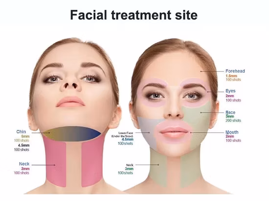 4D Hifu 기계 20000발 안면 성형 바디 슬리밍